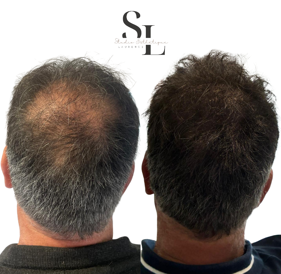 Micropigmentation capillaire homme