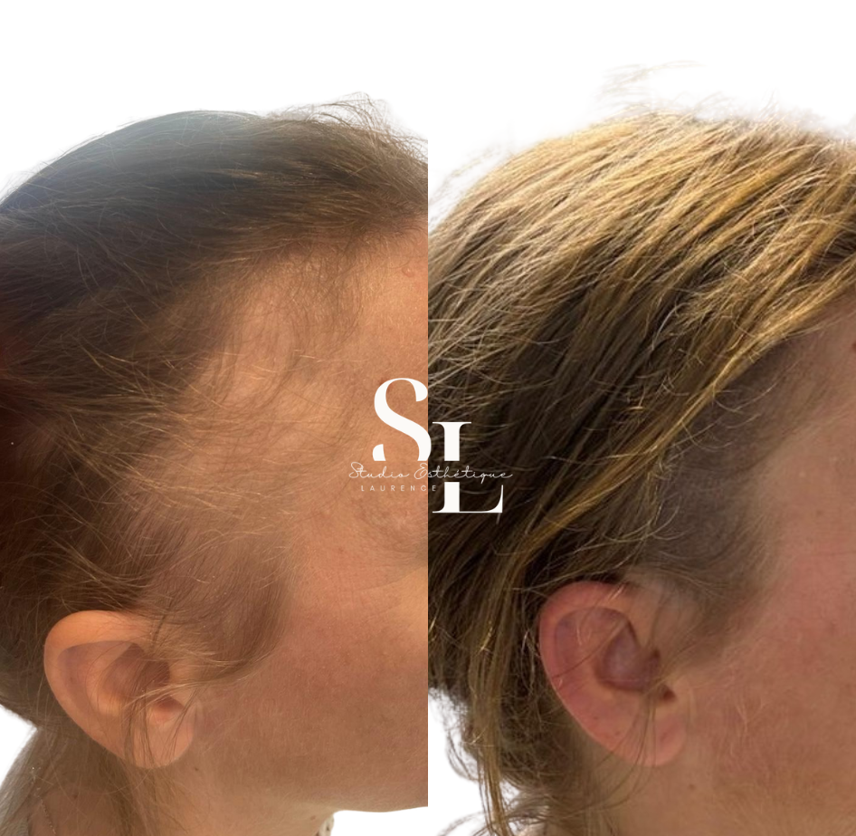 Micropigmentation capillaire femme